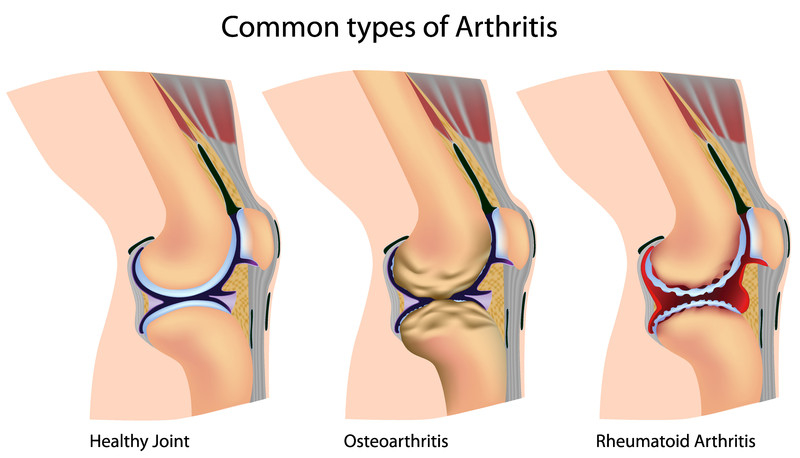 Stem Cell Therapy For Arthritis